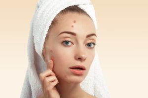 Three steps to treat acne